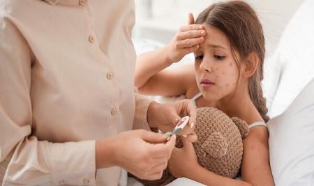 رژیم غذایی مناسب برای مبتلایان به آبله مرغان