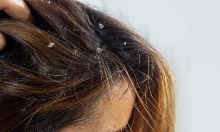 چگونه شوره سر را درمان کنیم؟