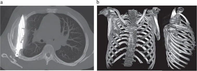اتفاق باورنکردنی؛ چاقویی که ۱۰سال در سینه این مرد فرو رفته بود و نمی‌دانست + عکس