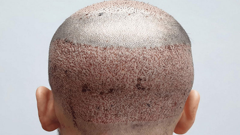 کاشت مو HRT چیست؟