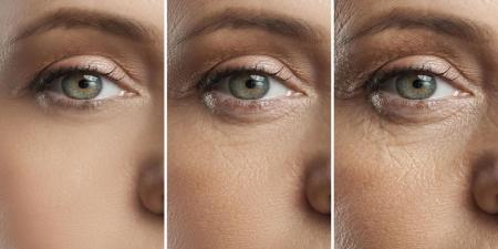 تکنیک طلایی برای درمان پیرچشمی